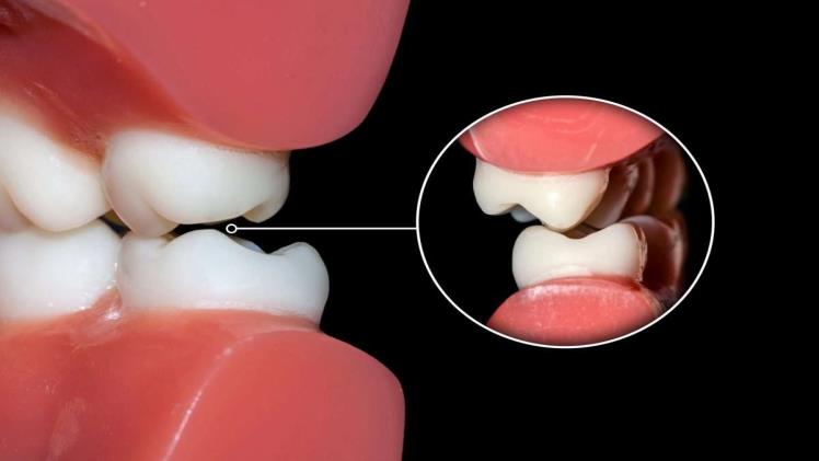 Biting Pattern Patterns of a Healthy Bite - Freshers web